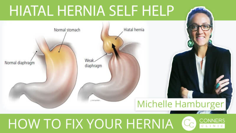 Hiatal Hernia Self-Help